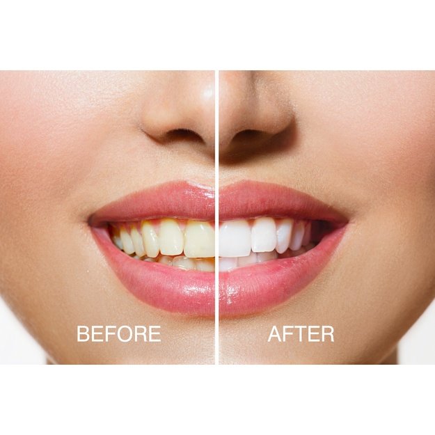 Rio USB Teeth Whitening