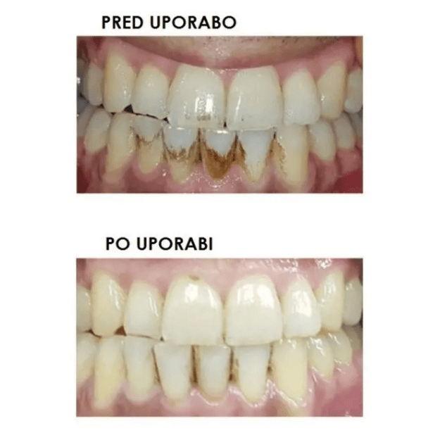 Silkn ToothWave TW1PE3001